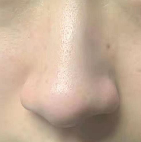 挽回发际线的方法,挽救发际线：有效方法简介