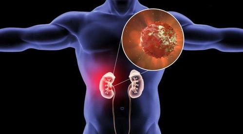 如何挽回脑瘤的同学,治疗脑瘤的方法和建议