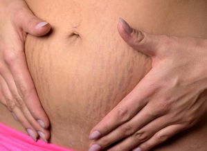 怎么挽回妊娠纹,有效方法：如何防止和减轻妊娠纹？