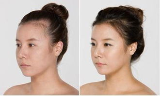 怎么将发际线挽回,挽救发际线：生发必经三步骤