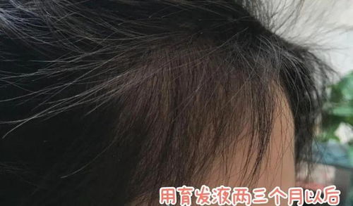 头发少可以挽回吗,头发少能否挽回？