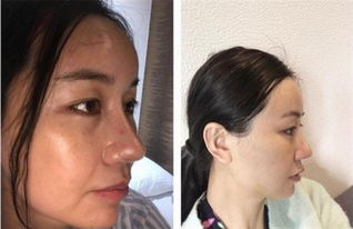 整容后为了挽回男友,挽回男友，美容手术再出发！)