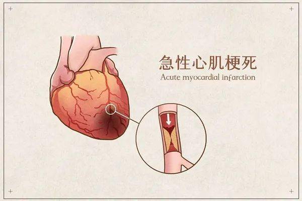 成功挽回心梗患者生命，成功拯救心脏病患者的生命