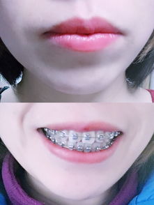 拔牙正畸脸变长怎么挽回，如何避免拔牙正畸导致脸变长，保持完美面部比例？