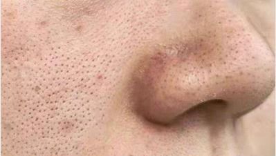 毛孔粗大还能挽回吗,如何有效缩小毛孔大小？