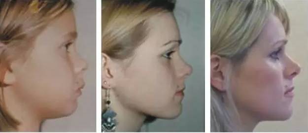 腺样体面容挽回,重塑面容