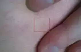 皮肤出血能挽回吗,皮肤出血是否能治愈？