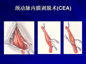 怎样挽回脑中风,如何有效挽回脑中风？