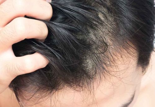 掉头发如何挽回,饮食须知：有效解决掉头发问题