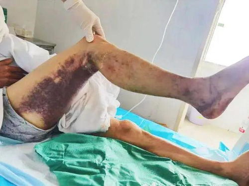 被蛇咬了怎么挽回,被蛇咬后的自救方法