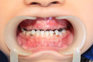 牙齿蛀了怎么挽回,挽回蛀牙的方法，不容错过！