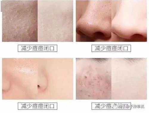 挽回好皮肤除藓,重获美肌：解决皮肤脱皮问题