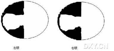 视野缺损可以挽回吗,挽救视野缺损：有救吗？)