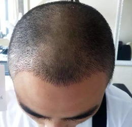 脱发人群怎么挽回,拯救脱发：挽救秀发的秘诀