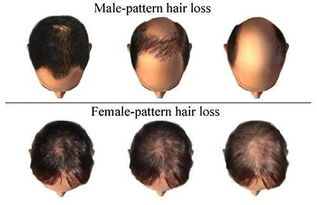 怎么将发际线挽回,挽救发际线：生发必经三步骤