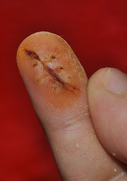 小拇指割伤不能挽回,小指割伤过深无法挽救