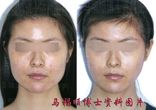 整容利息太高怎么挽回，如何降低整容手术所需的高额利息？