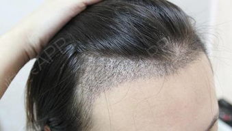 怎样挽回脱发女生颜面,挽回脱发女生的自信