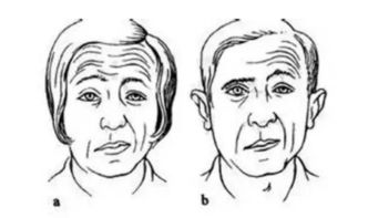 活得面不发怎么挽回,如何挽回没有表情的面瘫？