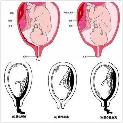 团队争分夺秒挽回脑疝,时间紧迫！团队全力挽回脑疝