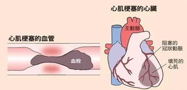 急性心梗患者挽回,挽救急性心肌梗死患者生命