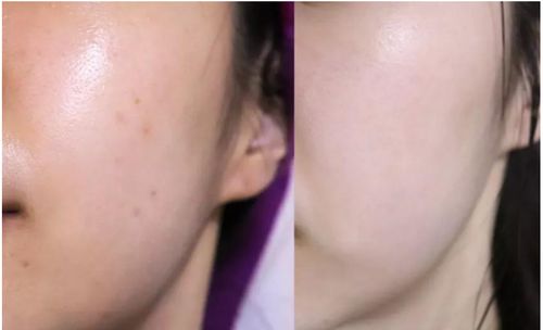 斑块破裂后怎么挽回,斑块破裂后如何修复