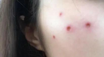 斑块破裂后怎么挽回,斑块破裂后如何修复