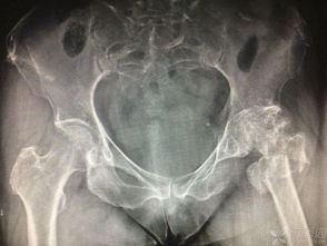 手臂骨头坏死怎么挽回,手臂骨头坏死如何治疗