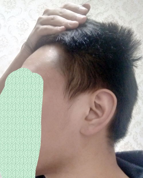 发际线高怎么挽回,发际线高怎么补救？