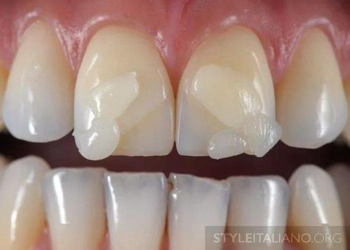 牙根腐蚀能挽回吗,牙根腐蚀可修复吗