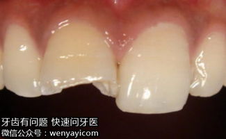 摔掉牙齿怎么挽回,牙齿掉了怎么办？快速挽回小技巧！