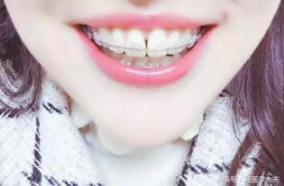 怎么挽回牙套脸,如何解决牙套造成的脸部变形？