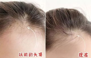 脱发了怎么挽回颜面,脱发后如何恢复头发生长