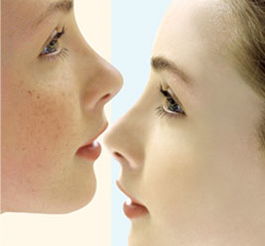 怎么挽回黄褐斑,有效祛斑方法，让你告别黄褐斑