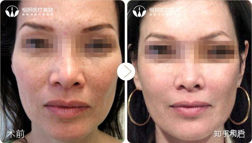 黄褐斑怎么挽回,如何改善黄褐斑？