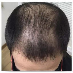 男人脱发严重怎么挽回,重返浓密头发的方法