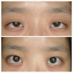 眼部肌肉下垂如何挽回,眼肌下垂，重拾青春神采