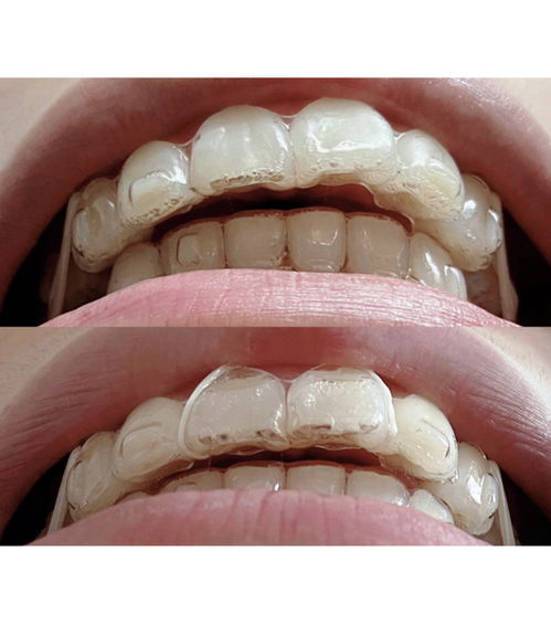 轻度龋齿可以挽回吗,如何拯救轻度龋齿？