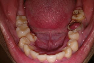 牙齿漏神经不能挽回,牙齿漏神经无法治愈，应该如何处理？