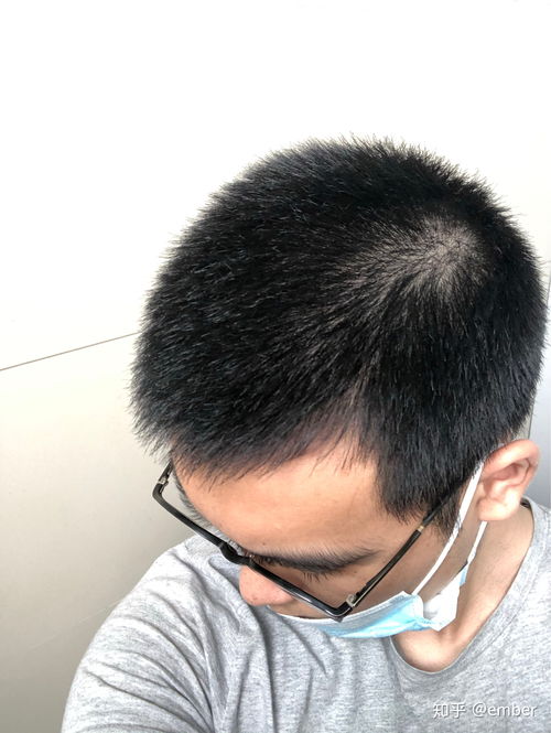 脱发早睡能挽回吗,能否逆转脱发？早睡是否有助于头发生长？