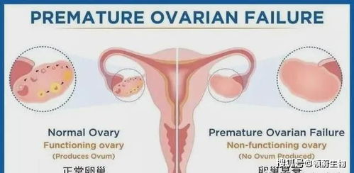 女性卵巢早衰怎么挽回,女性卵巢功能衰退怎么补救