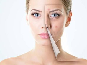 痤疮净帮你挽回面子,告别痘痘，还你自信