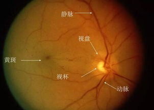 视网膜脱落如何挽回,视网膜脱落，应及早治疗！