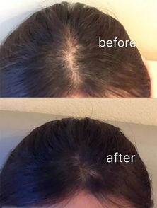 发际线后移怎么挽回,如何重振发际线？