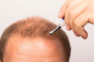 男生脱发怎么挽回,避免男性脱发，这些方法非常必要