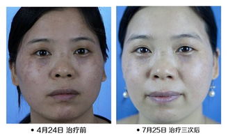 整容了还能挽回吗,整容毁容还来得及吗？