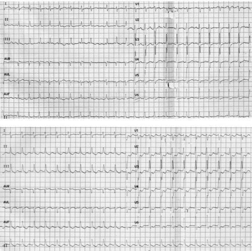 房颤能不能挽回,治疗房颤有望恢复正常心率