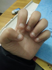 经常咬指甲怎么挽回,怎样改掉咬指甲的习惯？