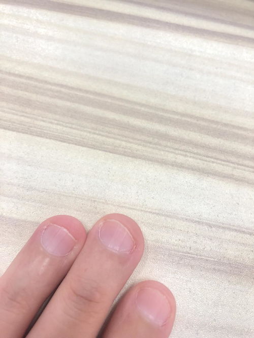 指甲变形还能挽回吗，如何拯救变形的指甲？