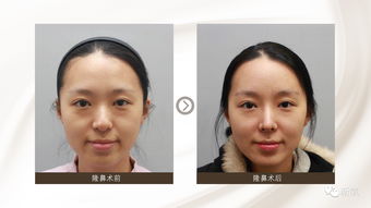 整容后挽回前男友,整容成功！成功挽回前男友！